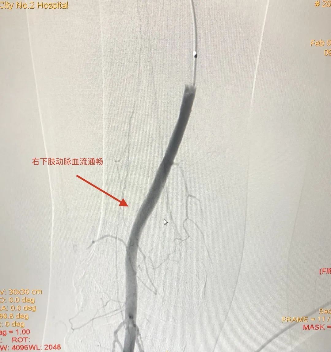 抗擊疫情不鬆懈,動脈溶栓保肢體