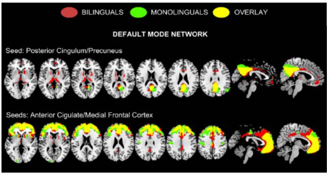 探索了单语和双语ad患者大脑葡萄糖代谢强度和连接的异常模式