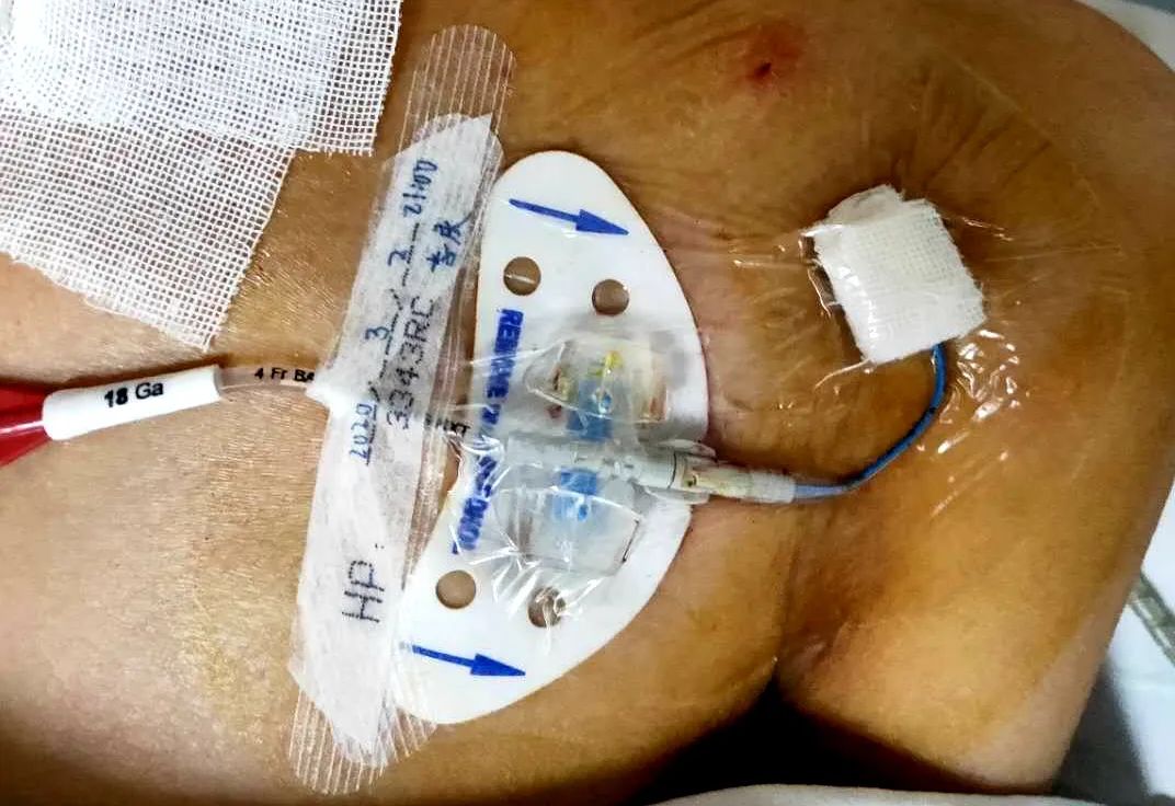 我院首例经腋静脉picc导管穿刺成功