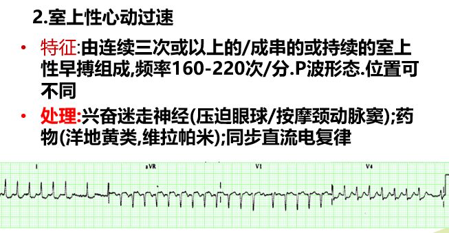 心电监护中常见异常波形的意义与常见报警原因及处理