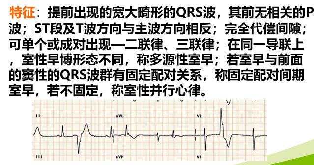 心电监护中常见异常波形的意义与常见报警原因及处理