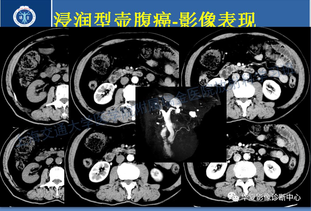 壶腹部癌的影像诊断