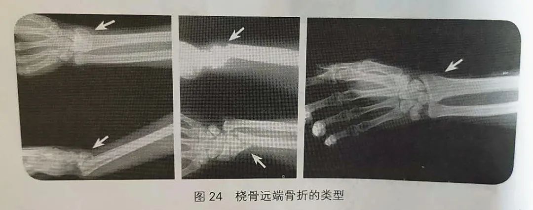 骨科康復橈骨遠端骨折的康復乾貨分享