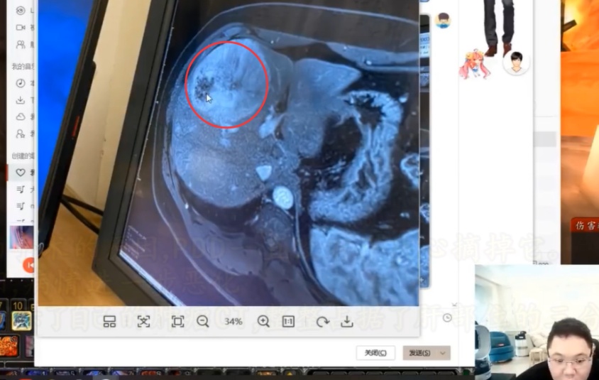 pdd肿瘤出血嫖老师不能再拖了必须尽快切除