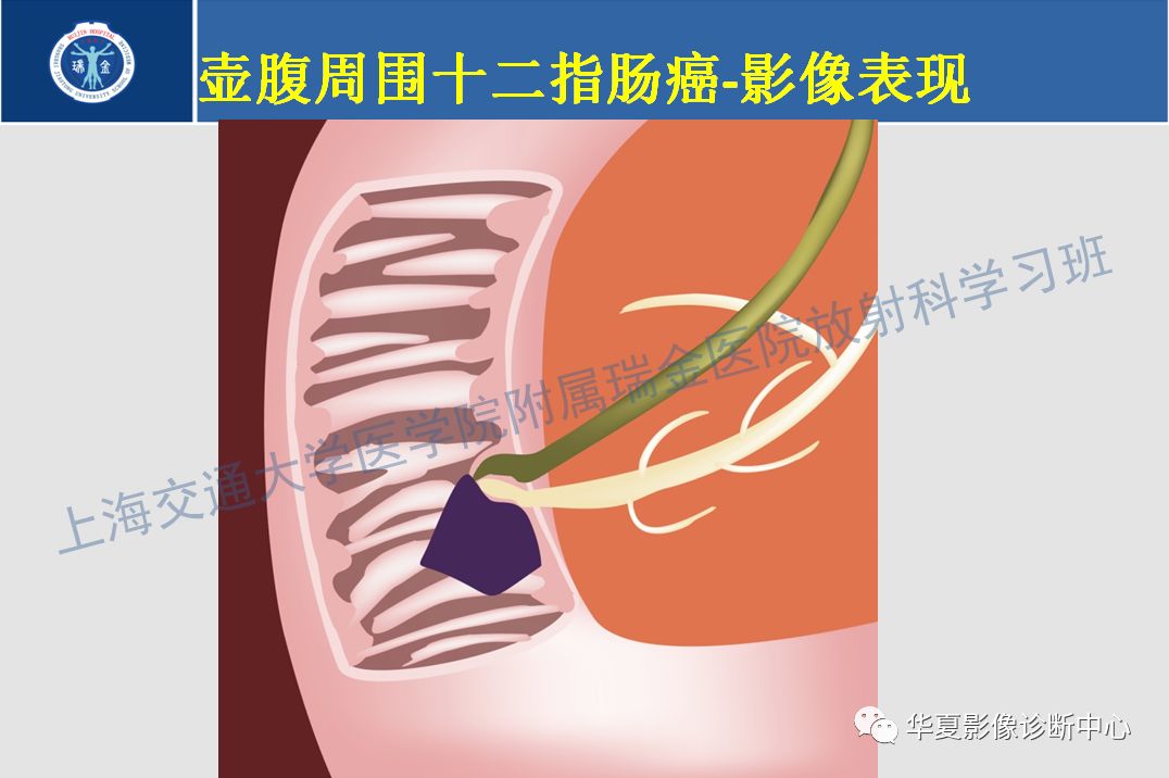 壶腹部癌的影像诊断