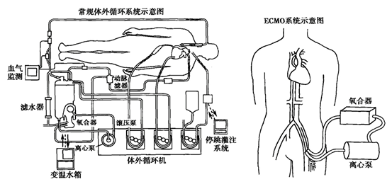 向死神买时间解密icu的终极武器ecmo