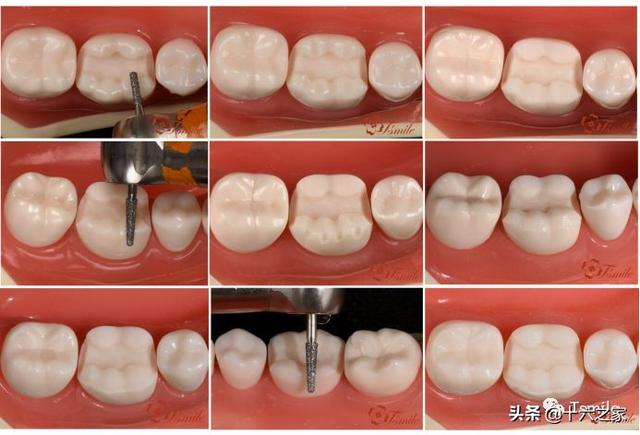 谭建国刘明月一步一步做好嵌体高嵌体牙体预备