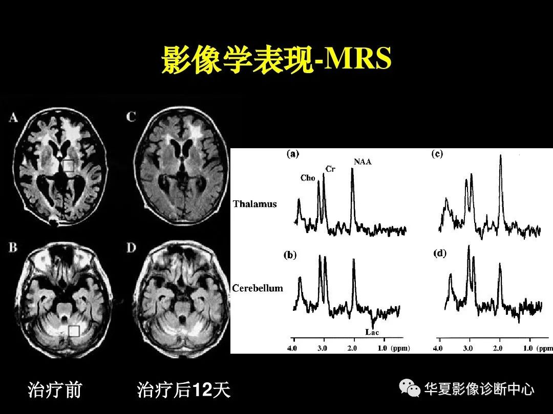 【影像基础】这个并不少见—韦尼克脑病的影像诊断