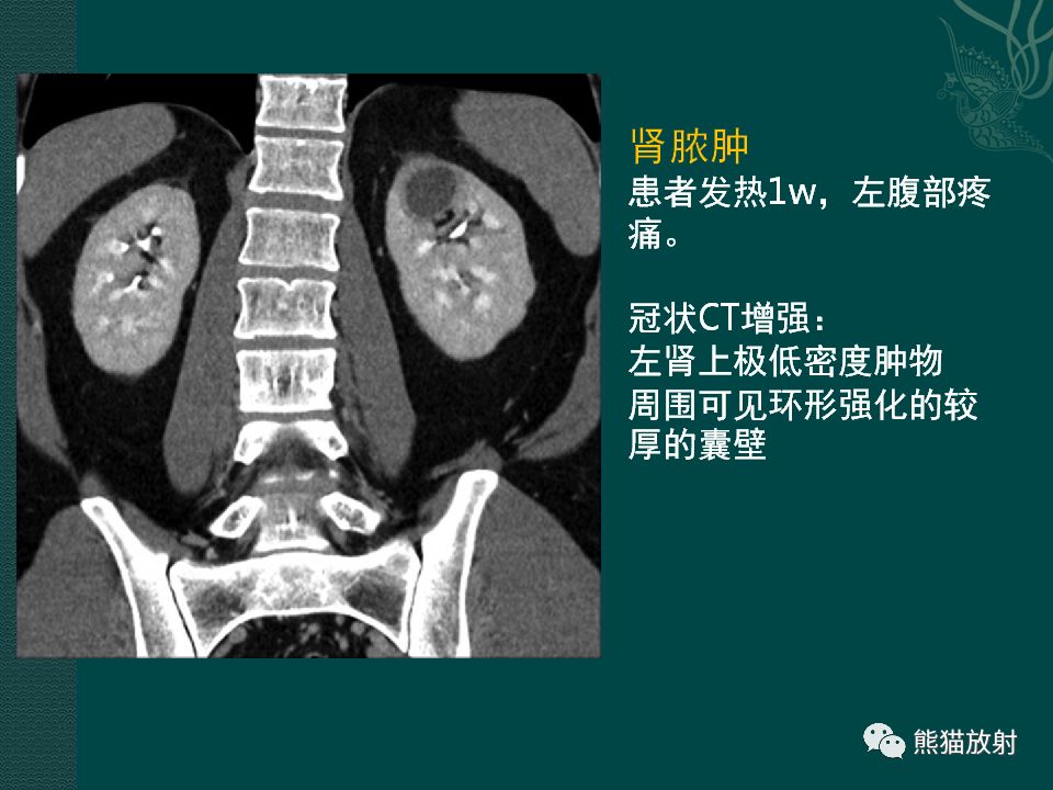 肾脏囊性病变的ct及mri表现