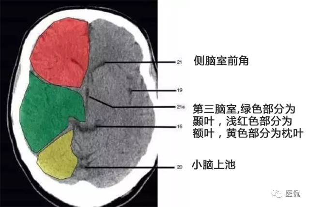 具体解释一节:基底节一环:脑底动脉环三体:垂体,松果体,胼胝体二囊:内