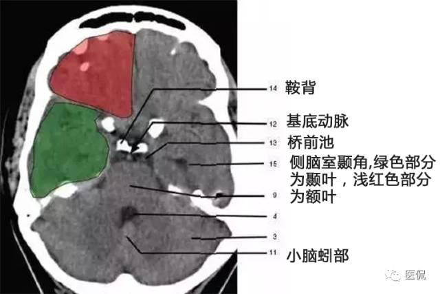 具體解釋一節:基底節一環:腦底動脈環三體:垂體,松果體,胼胝體二囊:內