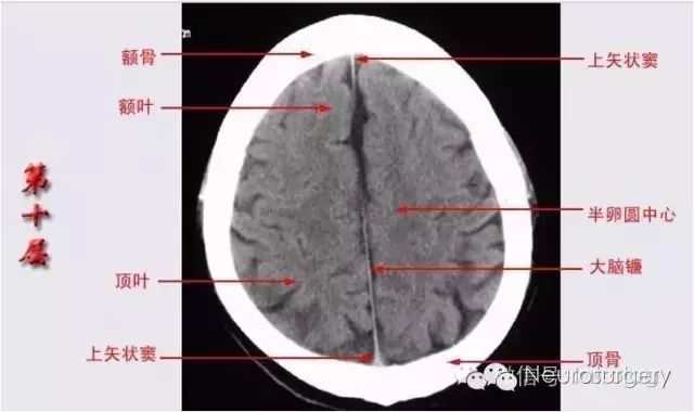 胼胝体二囊:内囊,外囊八池:二桥环枕四裂脚大九面:听眦蝶鞍三下上体顶