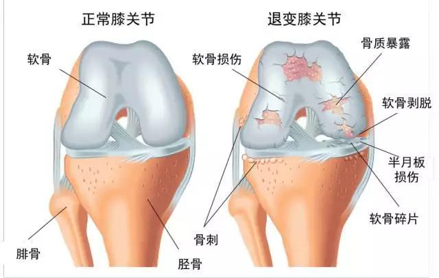 長期運動和長期坐著不動哪個更容易得膝關節疾病