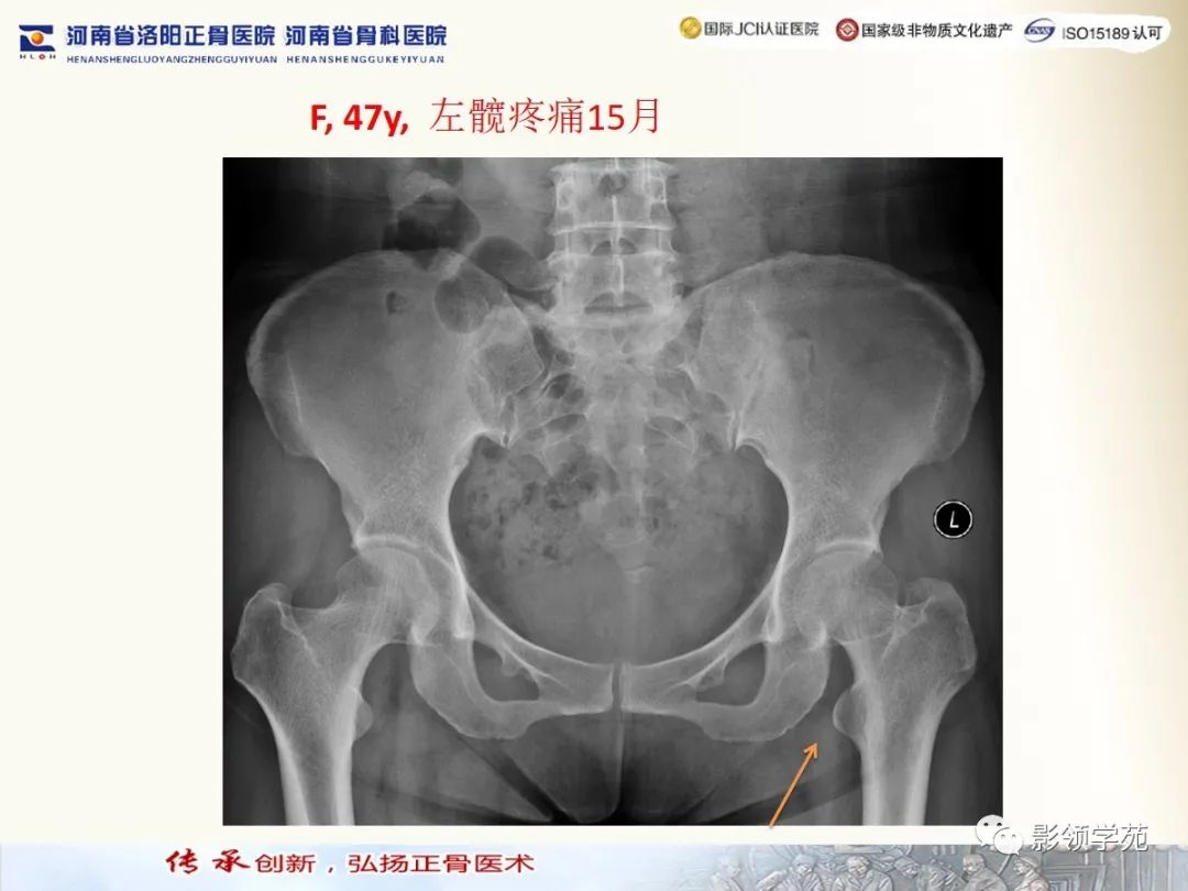 经典坐骨股骨撞击综合征