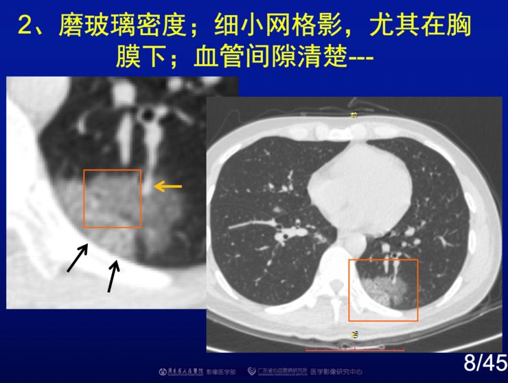 赵振军最全图文解读新冠肺炎ct早期诊断和鉴别诊断上