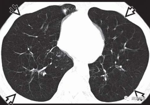 全小葉型間隔旁型肺氣腫丨ct診斷要點