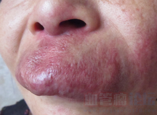 蔓状血管瘤并不少见关于它的手术治疗你知道多少