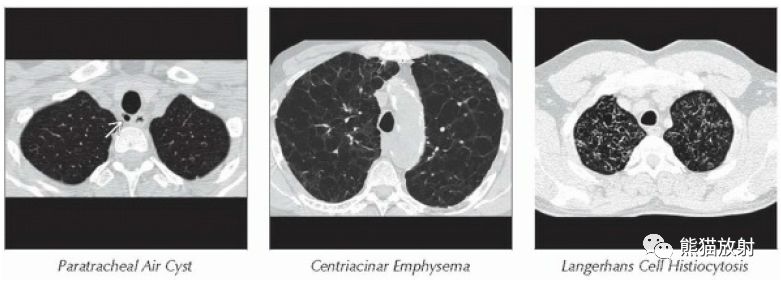 全小叶型间隔旁型肺气肿丨ct诊断要点