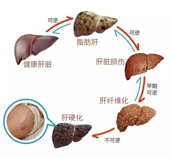 脂肪肝在发展到肝纤维化晚期之前都是一种可逆转的慢性病
