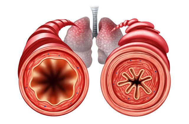 咳嗽,痰多,喘息,教你一招调理支气管炎,虽慢有效