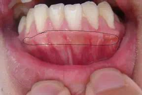 口腔念珠菌感染常常是hiv感染的最初表现,在口腔损害中最为常见;对绝