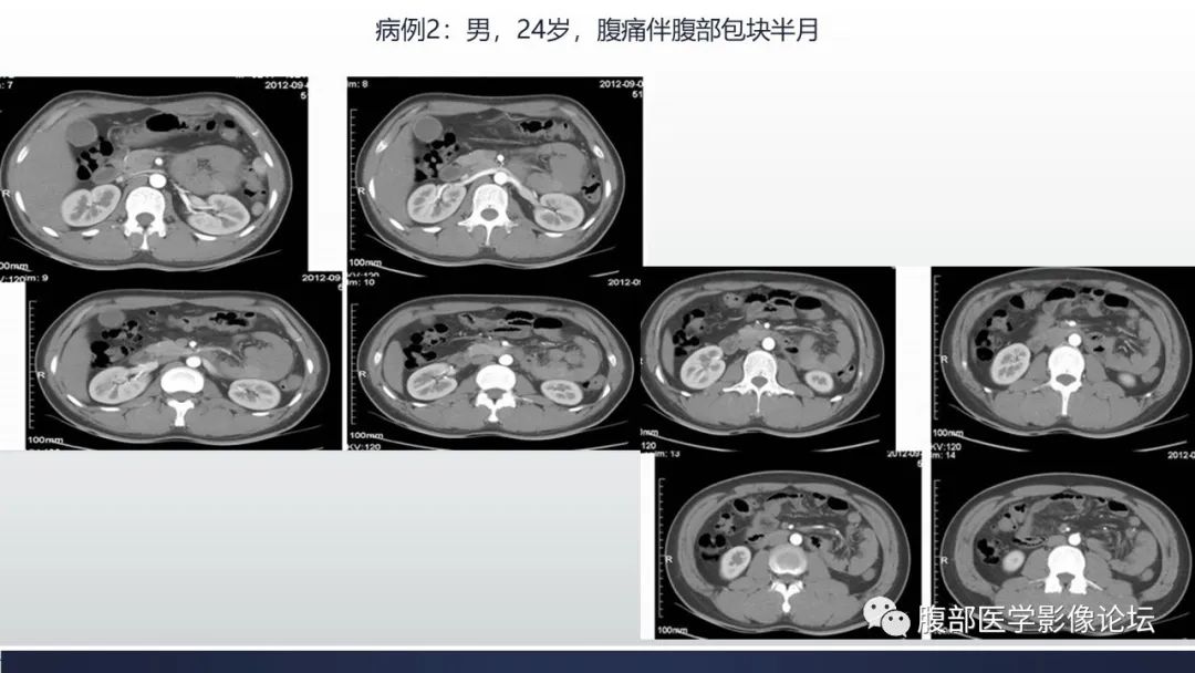 手把手教你丨腹內疝影像診斷,你想要的都在這裡!!!_徵象