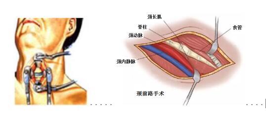 颈椎前路手术入路图解图片
