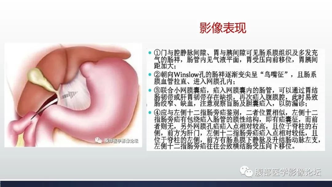 糾集,移位並充血水腫)絞窄性小腸梗阻徵象:1直接徵象,腸繫膜血管閉塞