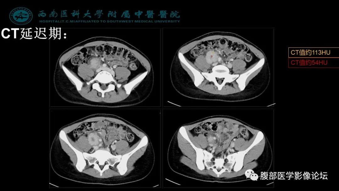 腹膜後丨髂窩淋巴結炎性假瘤