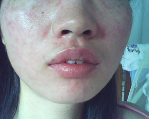 换季皮肤易过敏怎么办注意这几点别让皮肤过敏毁了你的春天