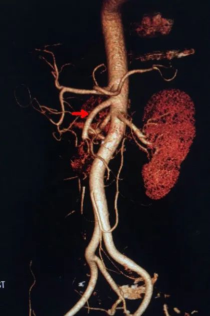 房颤患者的噩梦之不一样的急性腹痛——肠系膜上动脉栓塞