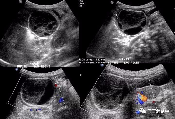 卵巢囊肿扭转图片图片
