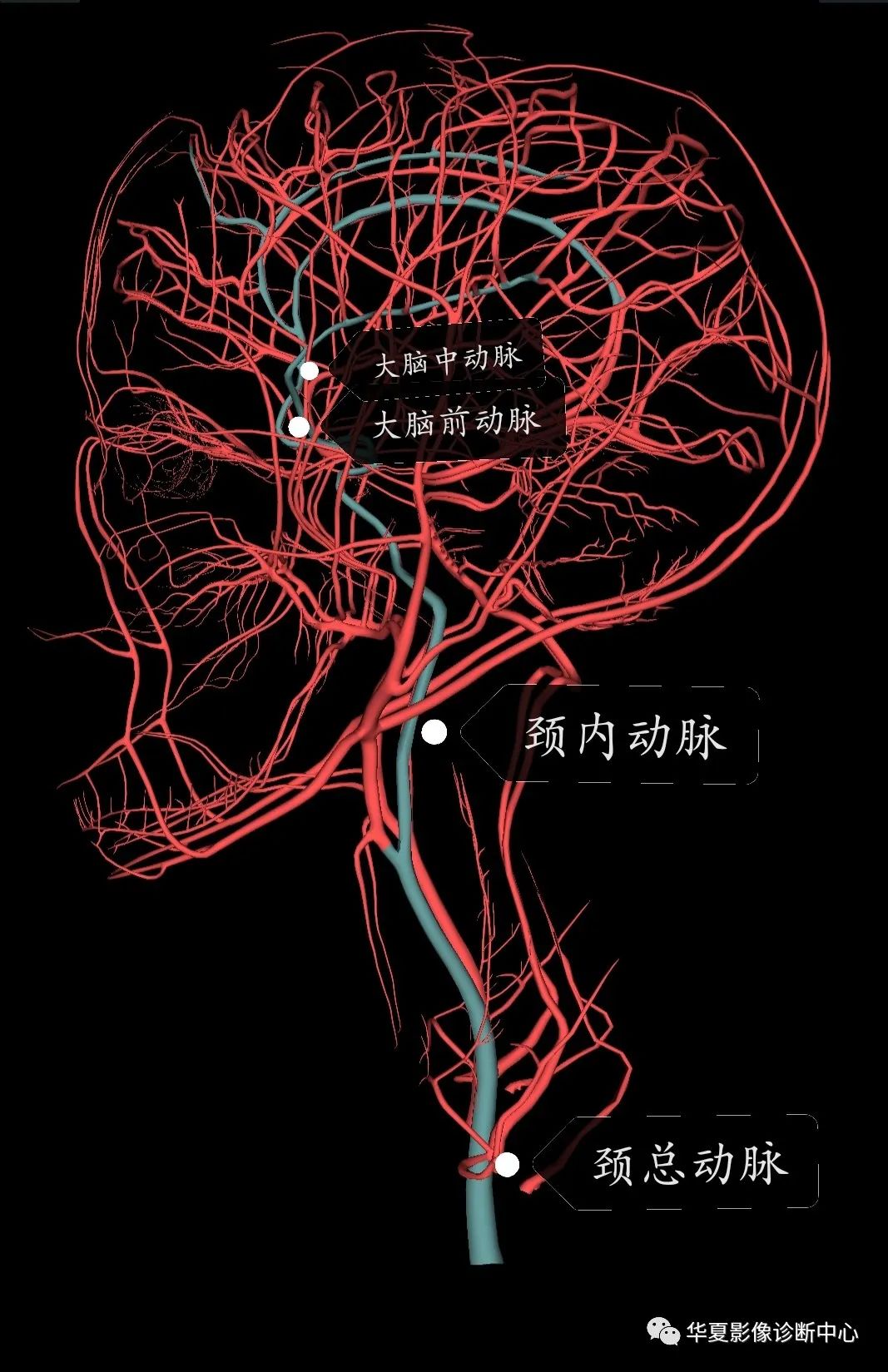 头颅血管成像图解图片