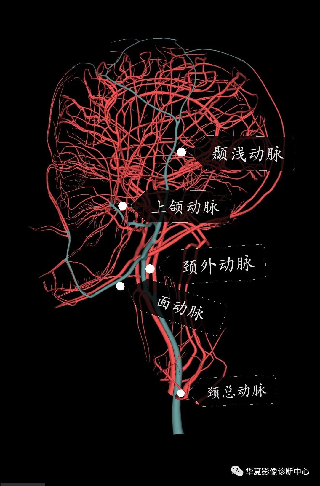 头颅血管成像图解图片