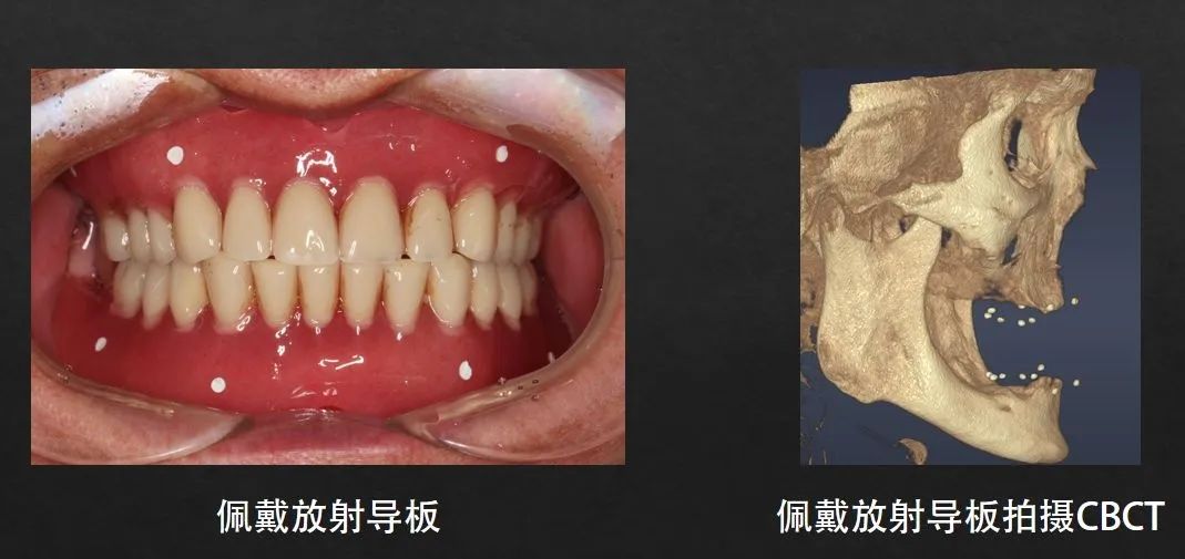 數字化導板信息採集▲數字化導板引導種植體植入由此可以看出,以