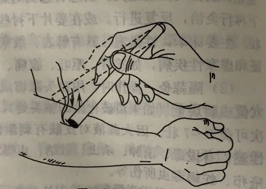 图2 雀啄灸(3)回旋灸:点燃艾条一端,与施灸皮肤虽保持一定的距离,但