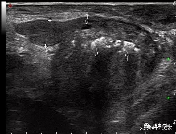 前列腺钙化彩超图片