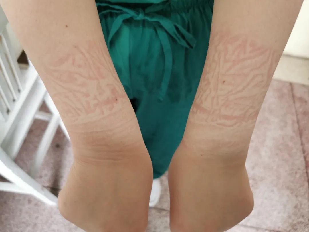 脱下防护服的她 脸上和手臂上满是压痕和勒痕她在护理患者的同时,也被