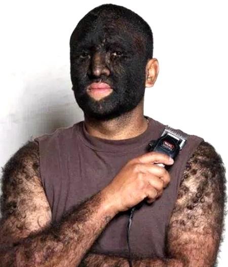 原创出生便患有多毛症体毛太多遭人排斥如今的模样却美翻全场