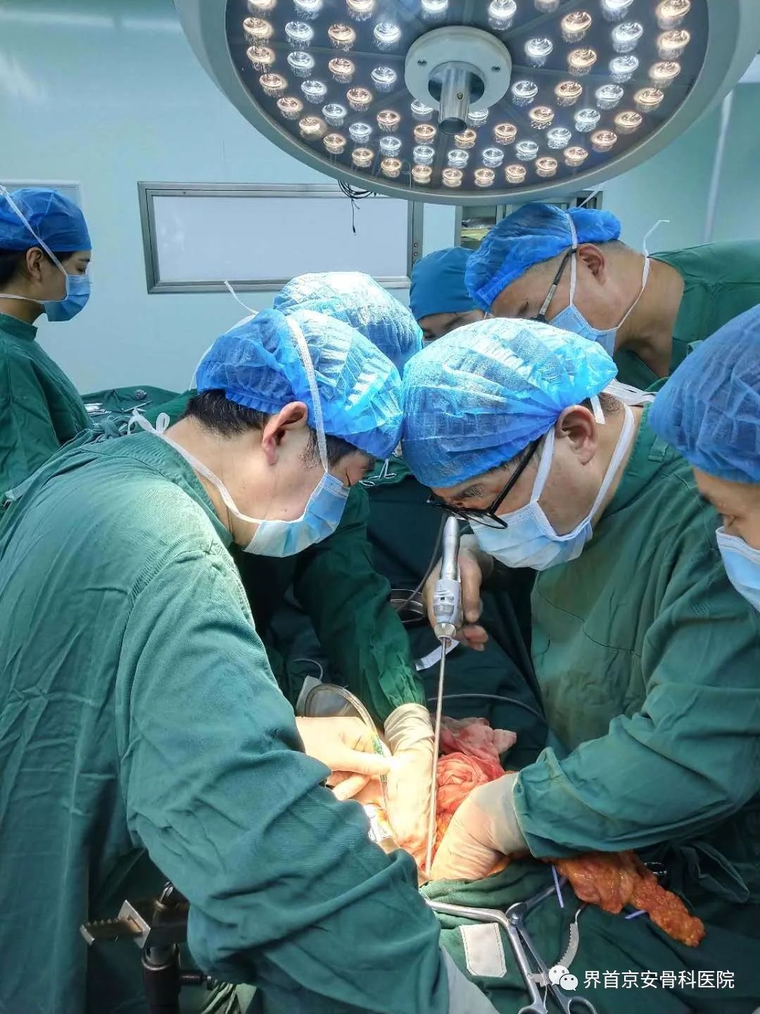界首京安丨我院普外科成功完成"巨脾切除"手术