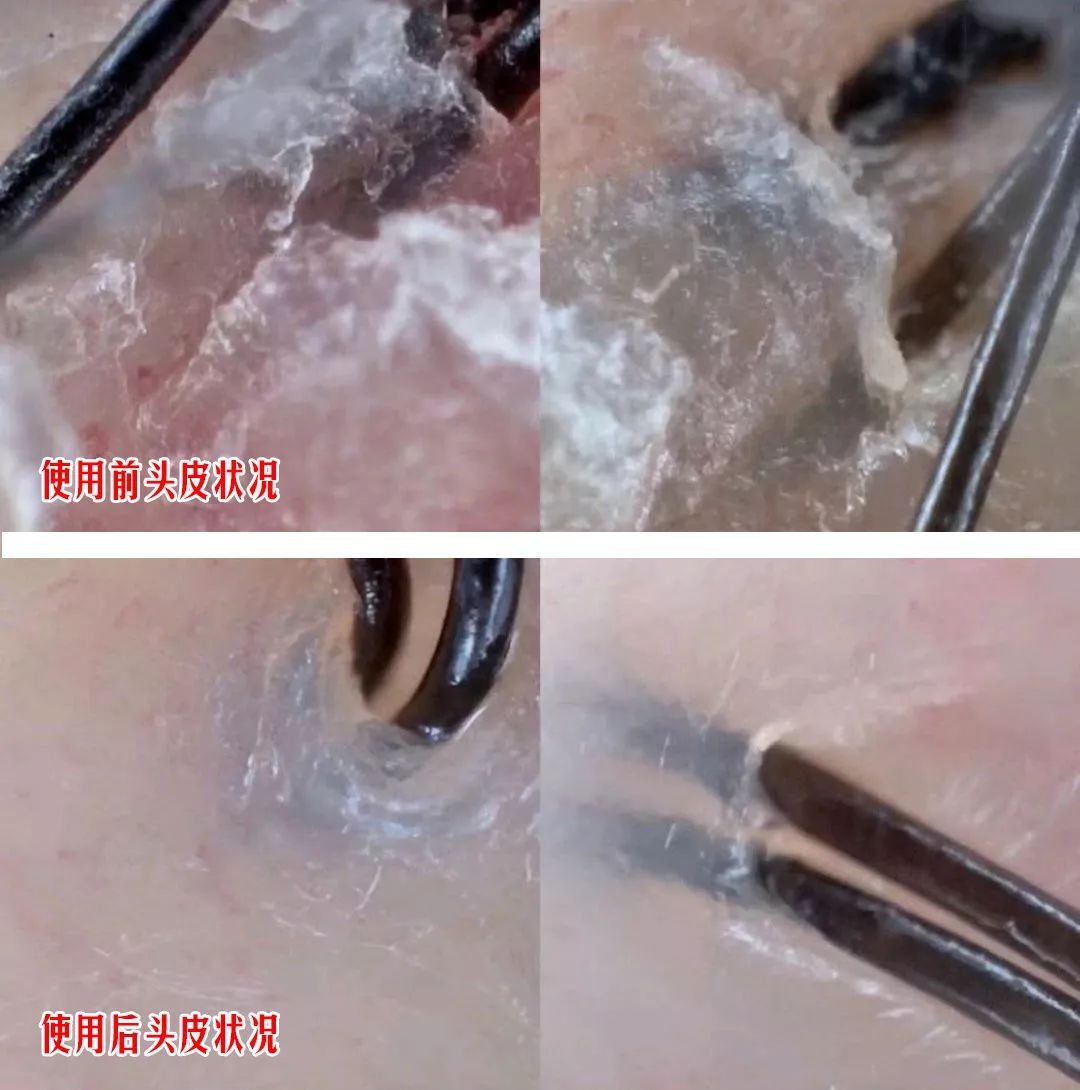 头上又油又痒的原因竟然都是螨虫的排泄物大油头清洁器用它3天不洗头