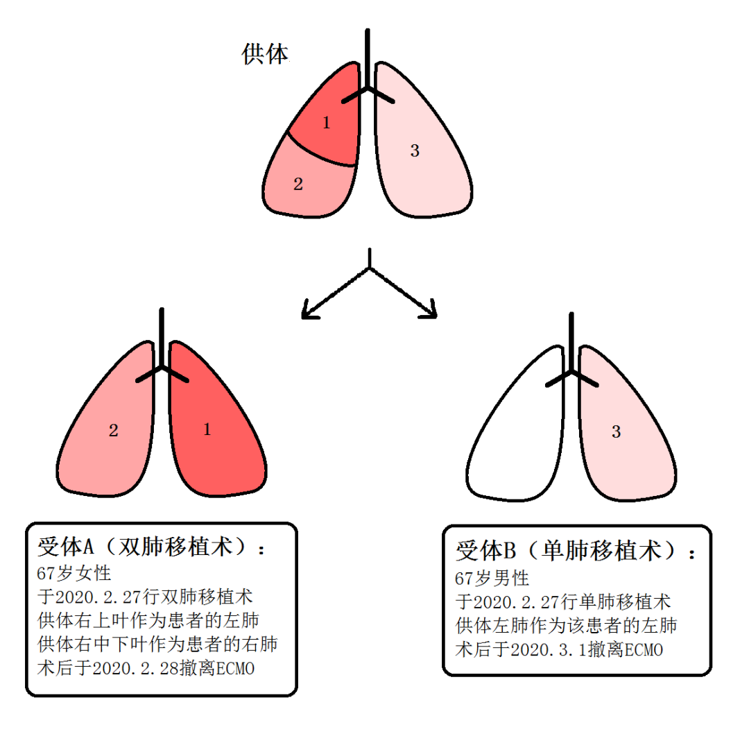 感动12天6台肺移植其中一例1人肺救2人命为全球首例成功尝试