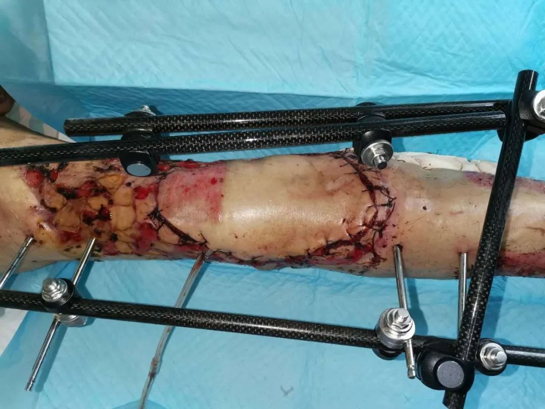 大腿截肢手术图片真实图片