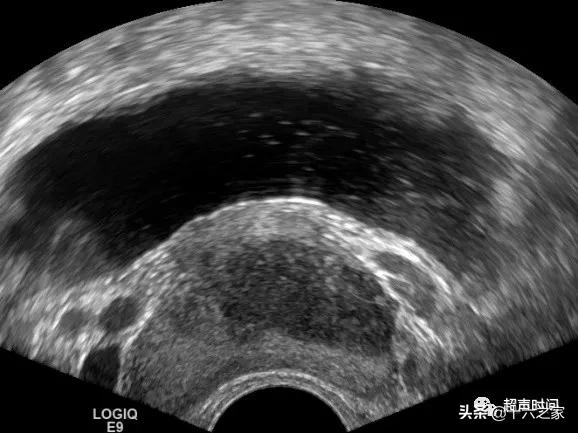 前列腺那些事兒4結石鈣化囊腫和其他