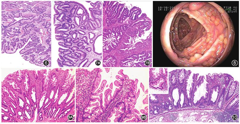 一张图看懂胃肠道腺瘤和良性上皮性息肉的病理诊断共识