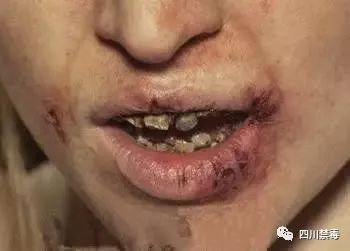 吸毒后的男女如此造孽!冰毒竟如此恐怖,转发周知