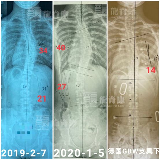 复查才发现:孩子佩戴的国产支具是没用的软支具,对脊柱没有一点推动力