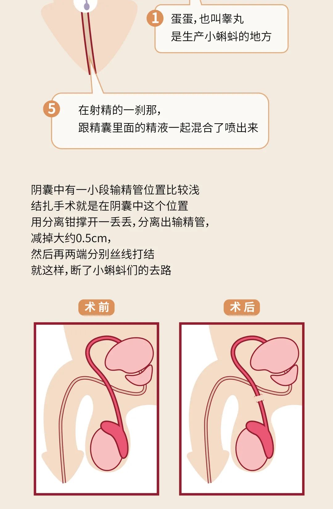 输精管结扎术步骤图片