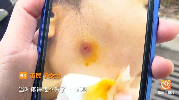 常州一女子疑似注射瘦脸针失败脸颊溃烂流脓致毁容
