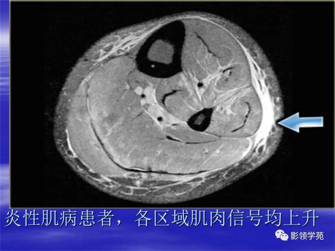 非创伤性肌肉病变的mr表现